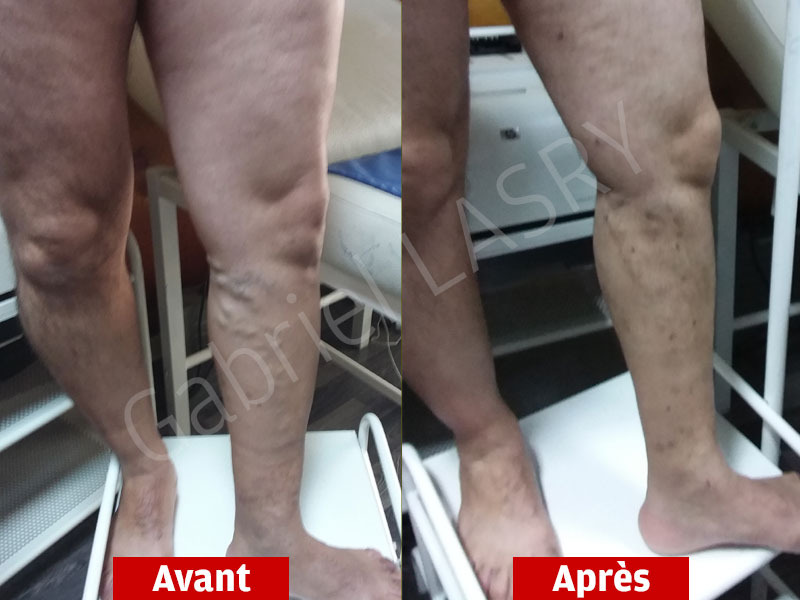 resultats-operation-varices-avant-apres4 Avant/Après